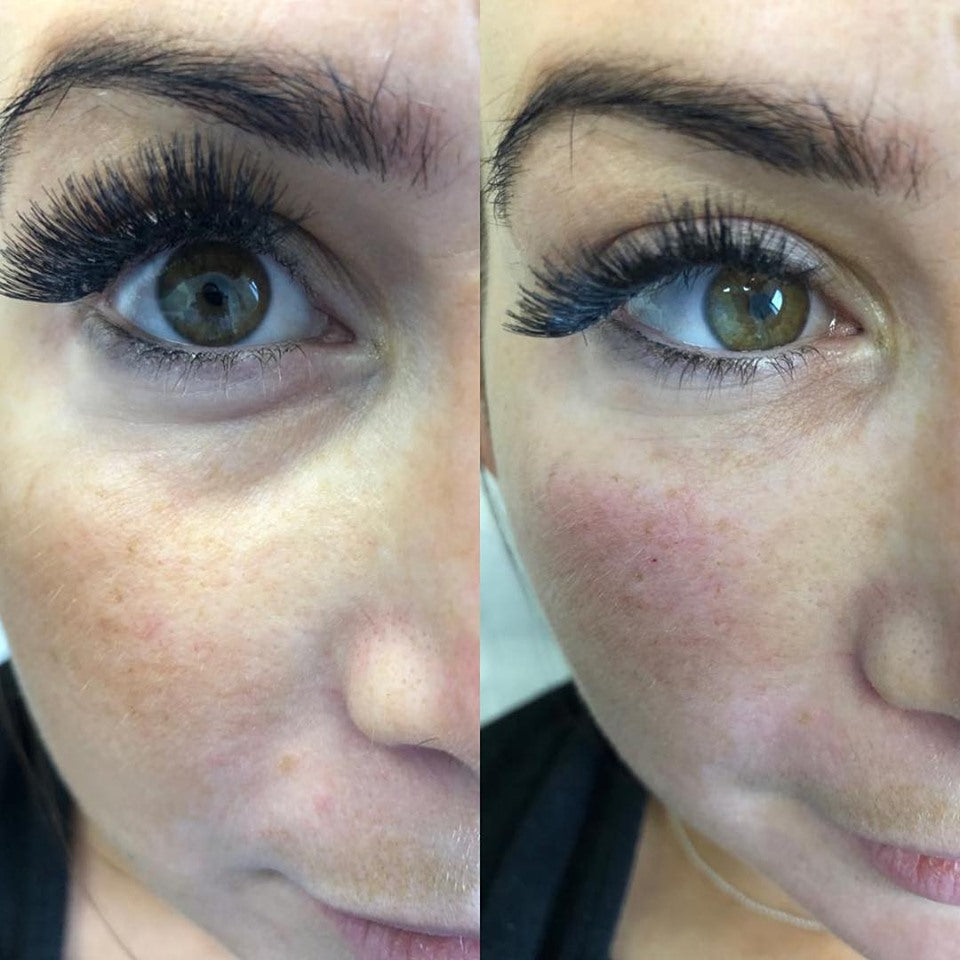 INHOUSE - Ultimate Advanced Fillers - Nose & Tear Trough Masterclass