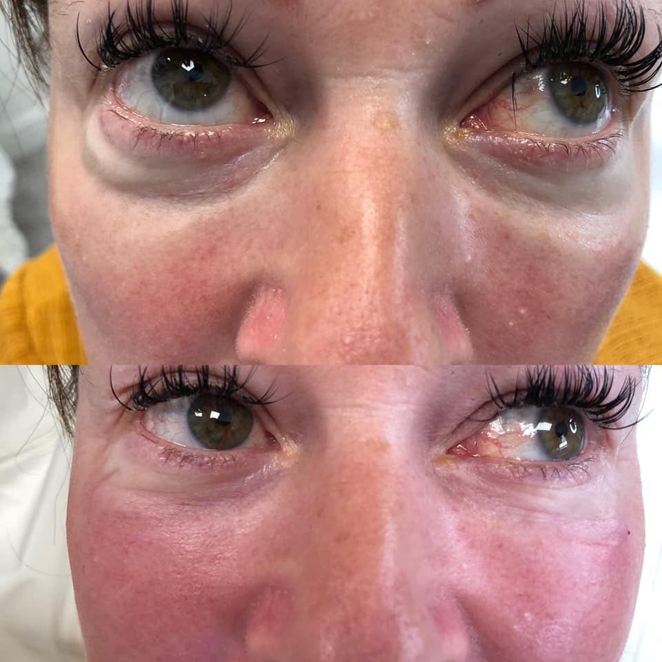 INHOUSE - Ultimate Advanced Fillers - Nose & Tear Trough Masterclass