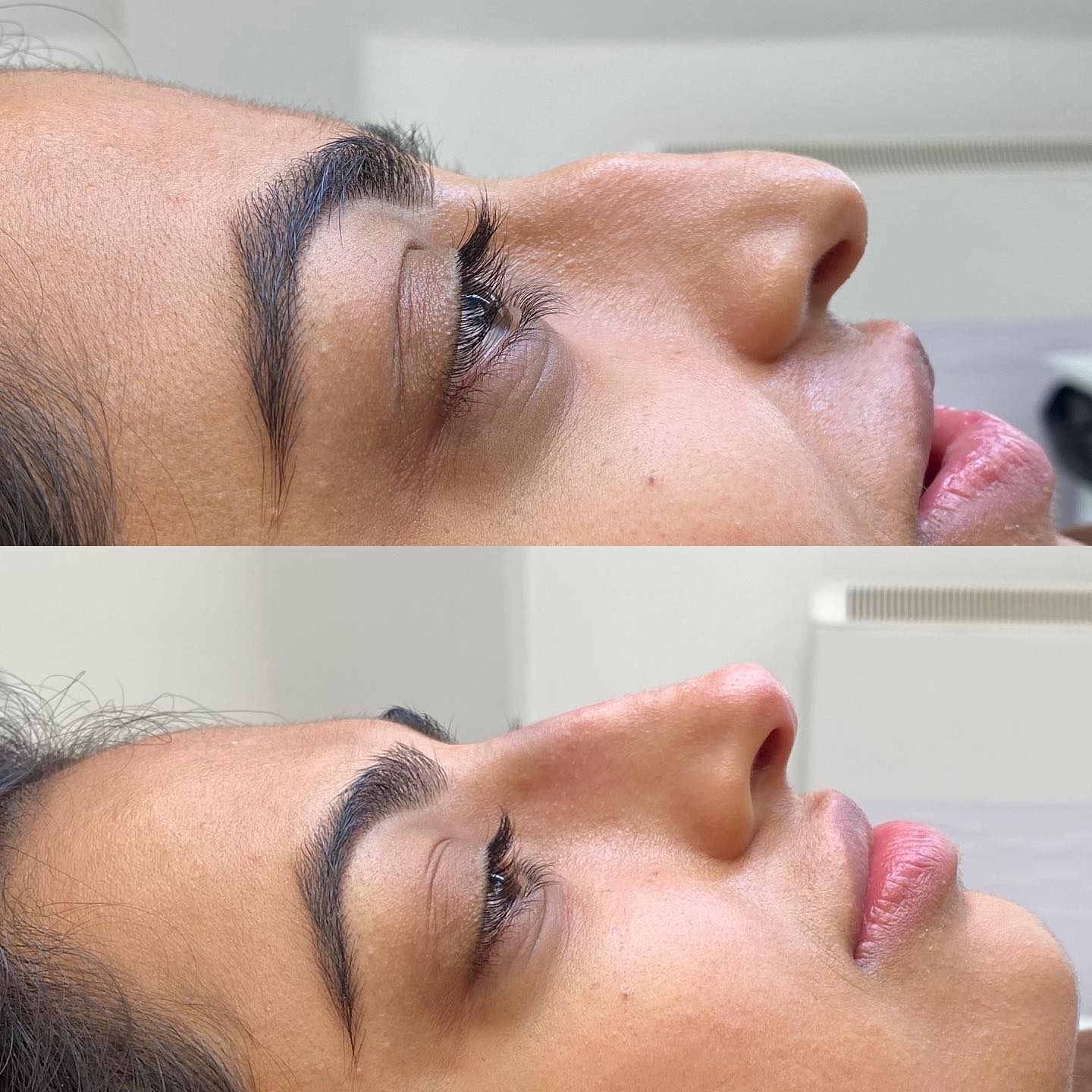 INHOUSE - Non-Surgical Rhinoplasty Training Masterclass