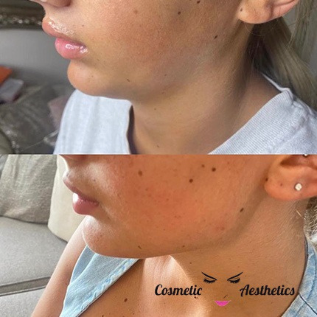 Jawline Chin Facial Cannula Masterclass Online Training Course jawline-chin-facial-cannula-masterclass-online-training-course