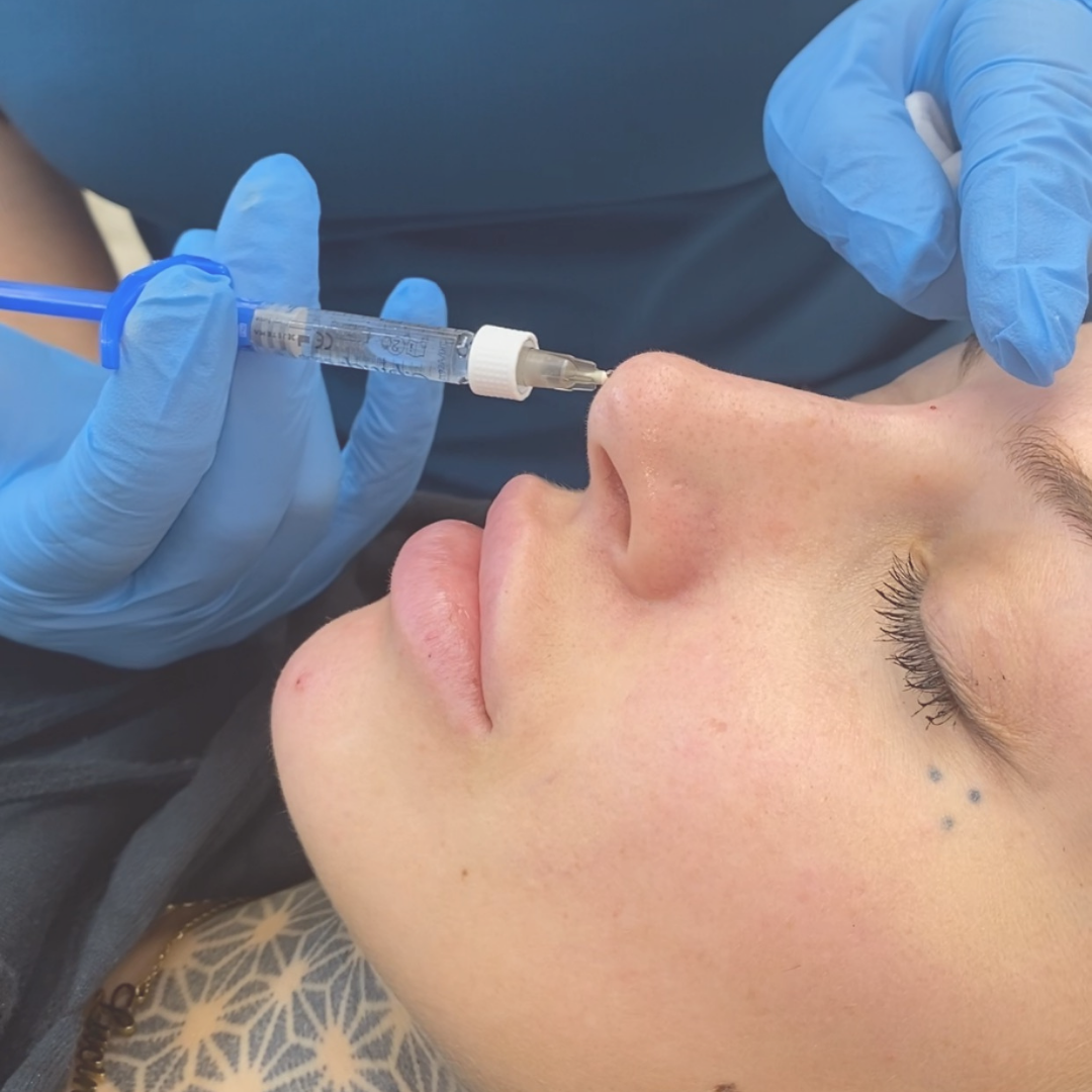 INHOUSE - Ultimate Advanced Fillers - Nose & Tear Trough Masterclass