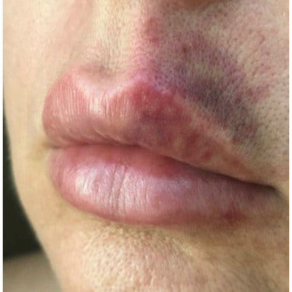 In-house Complications Course Dermal Fillers & Botulinum Toxin