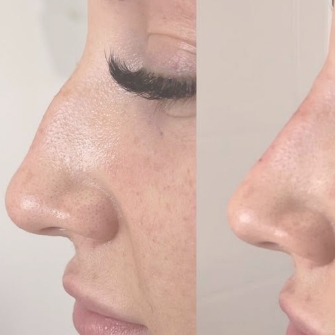 Ultimate Advanced Dermal Filler Course Includes Rhinoplasty (Nose) and Tear Trough £500 plus vat