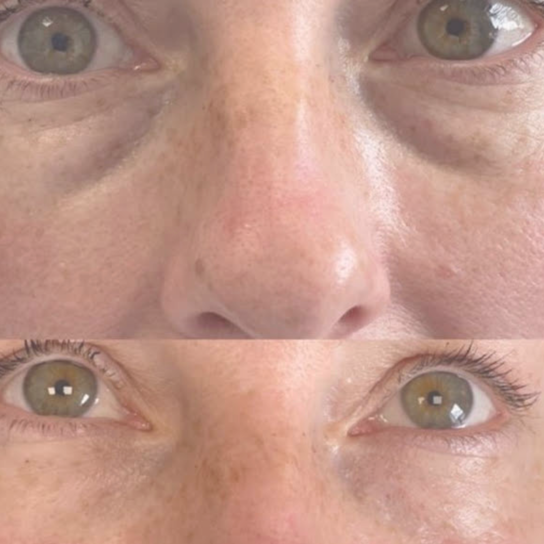 Ultimate Advanced Dermal Filler Course Includes Rhinoplasty (Nose) and Tear Trough £500 plus vat