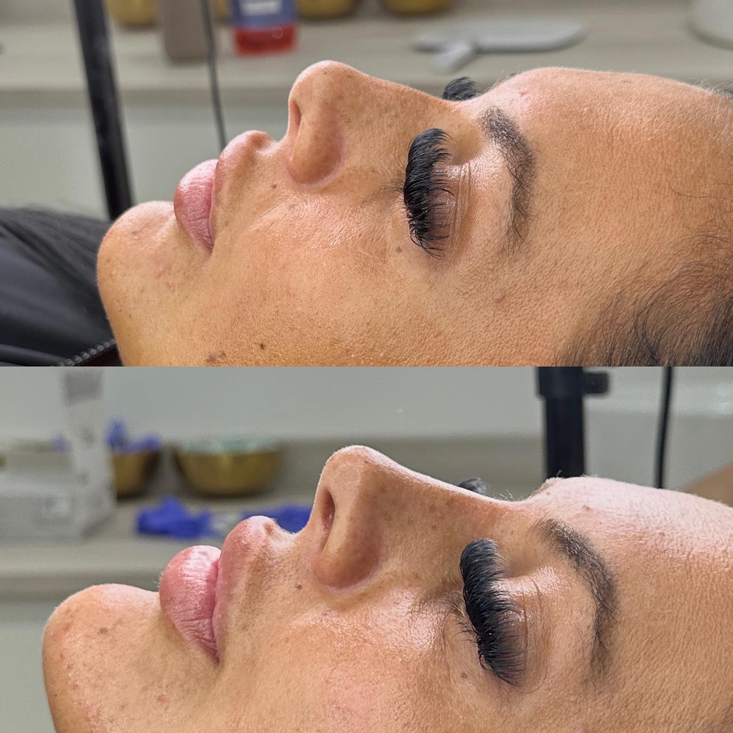 Ultimate Advanced Fillers - Nose & Tear Trough - (Accredited)