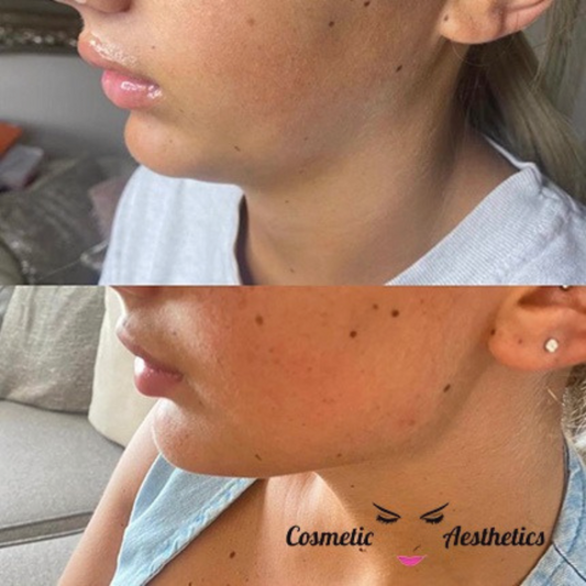 ONLINE - Jawline & Chin Facial Cannula Masterclass