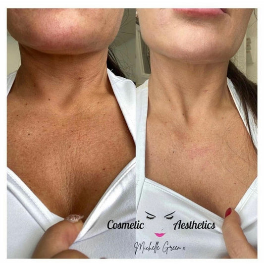 ONLINE - Profhilo Face and Body Course